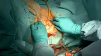 Uterine prolapse surgery